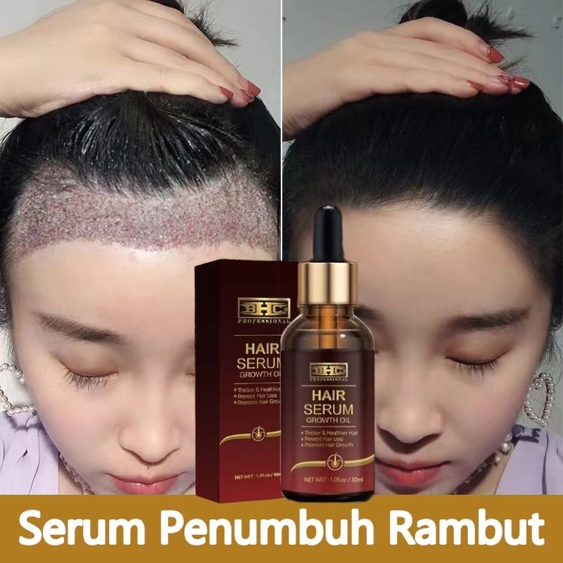 Serum Penumbuh Rambut Anti Botak HAIR SERUM / SERUM RAMBUT / HAIR GROWHT PENUMBUH RAMBUT BOTAK AMPUH ORIGINAL Hair Tonic Hair Tretmen Androgenetic alopecia — foto 3