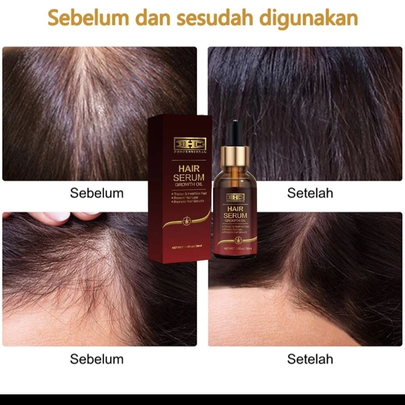 Serum Penumbuh Rambut Anti Botak HAIR SERUM / SERUM RAMBUT / HAIR GROWHT PENUMBUH RAMBUT BOTAK AMPUH ORIGINAL Hair Tonic Hair Tretmen Androgenetic alopecia — foto 5
