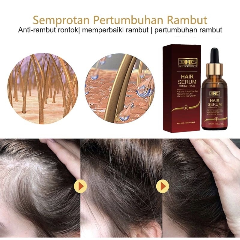 Serum Penumbuh Rambut Anti Botak HAIR SERUM / SERUM RAMBUT / HAIR GROWHT PENUMBUH RAMBUT BOTAK AMPUH ORIGINAL Hair Tonic Hair Tretmen Androgenetic alopecia — foto 6